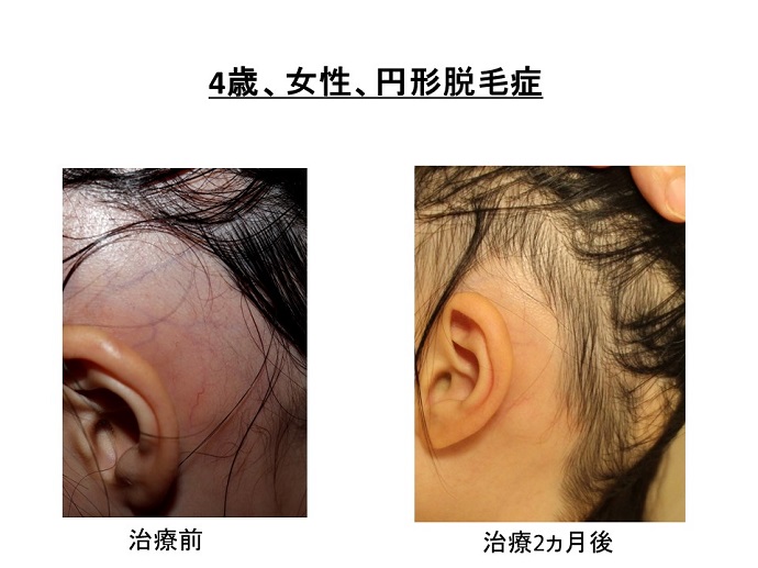 円形脱毛症　病院